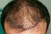 haartransplantatie